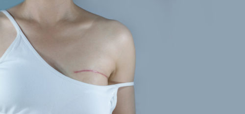breast reconstruction malvern