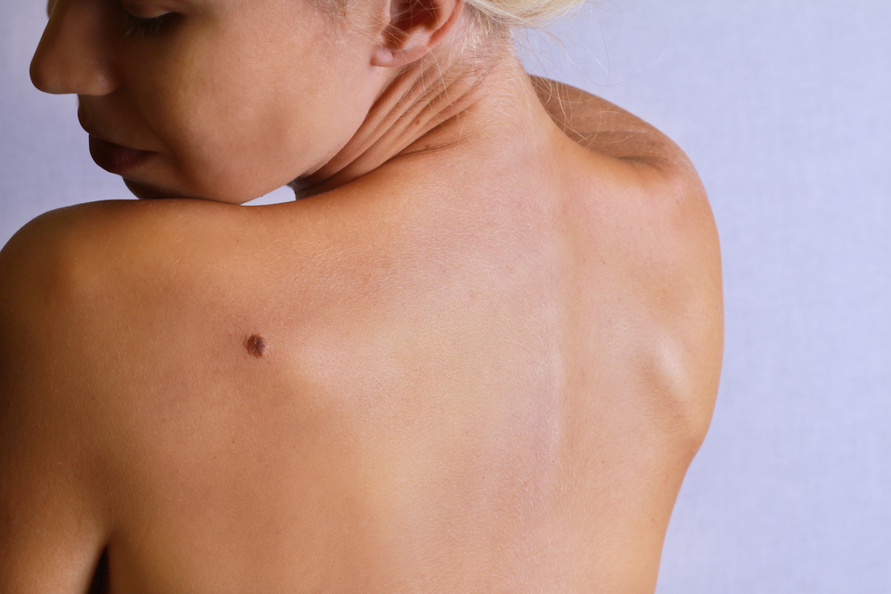 skin lesion melbourne