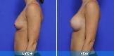 Breast Augmentation