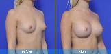 Breast Augmentation