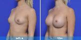 Breast Augmentation