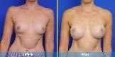 Breast Augmentation