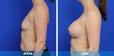 Breast Augmentation