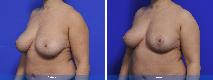 Breast Reduction