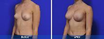 Breast Augmentation