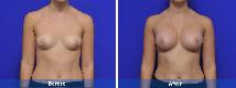 Breast Augmentation