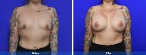 Breast Augmentation