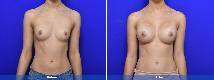 Breast Augmentation