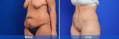 Abdominoplasty