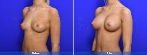 Breast Augmentation