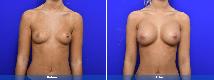 Breast Augmentation