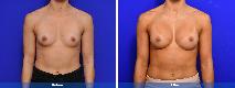 Breast Augmentation