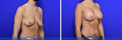 Breast Augmentation with Mastopexy/Lift