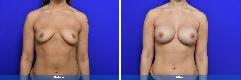 Breast Augmentation