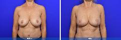 Breast lift / reduction