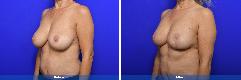 Breast lift / reduction