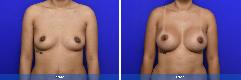 Breast Augmentation