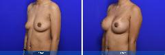 Breast Augmentation