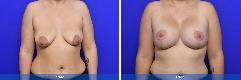 Breast Augmentation & Lift