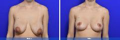 Breast Augmentation & Lift