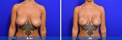 Breast lift / reduction