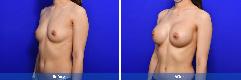 Breast Augmentation