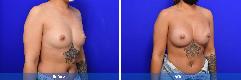 Breast Augmentation