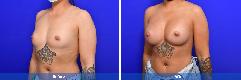 Breast Augmentation