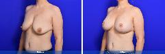 Breast Augmentation & Lift