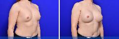 Breast Augmentation Revision