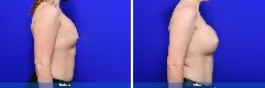 Breast Augmentation Revision