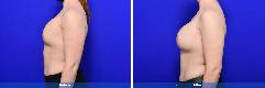 Breast Augmentation Revision