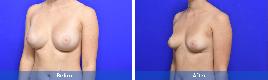 Breast Augmentation