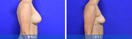 Breast Augmentation