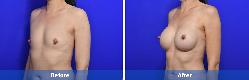 Asian Breast Augmentation