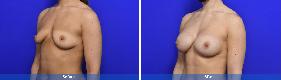 Subfascial / Prepectoral