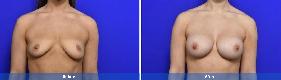 Subfascial / Prepectoral