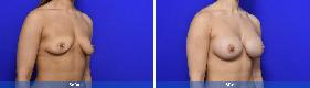 Subfascial / Prepectoral
