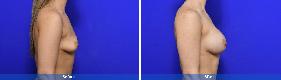 Subfascial / Prepectoral