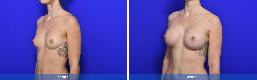 Subfascial / Prepectoral