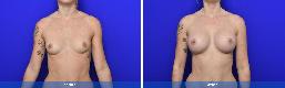 Subfascial / Prepectoral