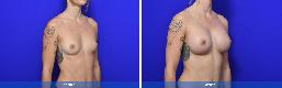 Subfascial / Prepectoral