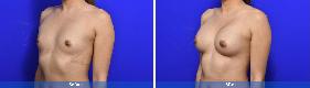Asian Breast Augmentation