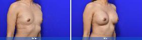 Asian Breast Augmentation