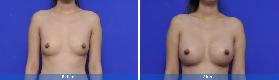 Asian Breast Augmentation