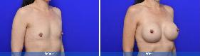 Asian Breast Augmentation