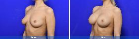 Subfascial / Prepectoral