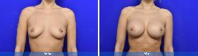 Subfascial / Prepectoral