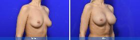 Subfascial / Prepectoral