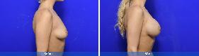 Subfascial / Prepectoral